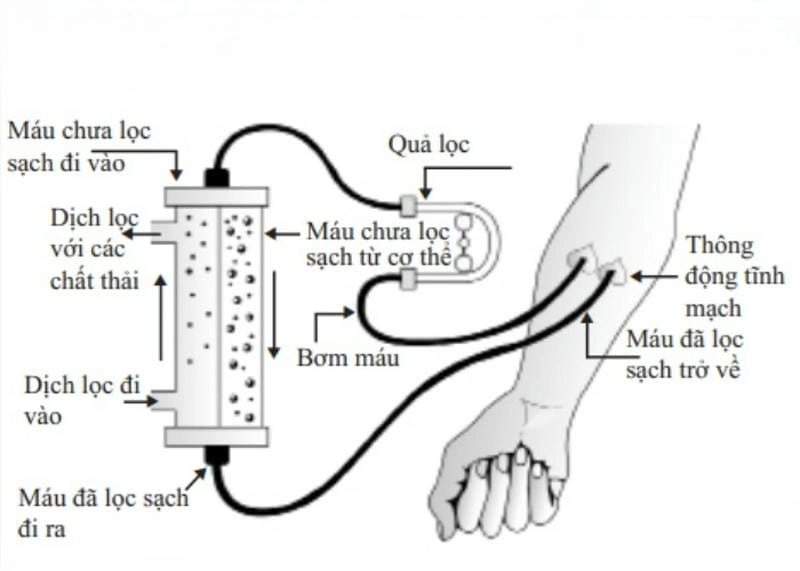 Tìm hiểu quá trình lọc máu diễn ra như thế nào