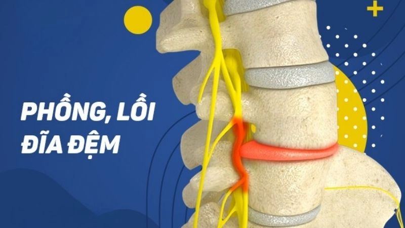 Chứng phồng lồi đĩa đệm được chẩn đoán dễ dàng qua các kỹ thuật hình ảnh
