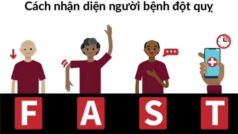 Nhận biết sớm biểu hiện đột quỵ bằng quy tắc “FAST”
