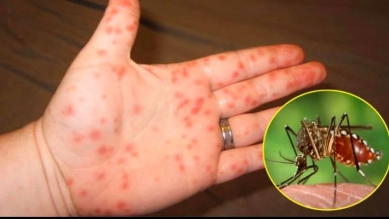 Bệnh sốt xuất huyết Dengue có biểu hiện lâm sàng đa dạng