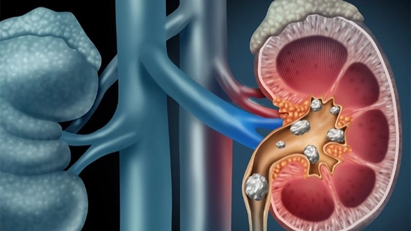 Sỏi còn tồn tại trong đường tiết niệu, là một yếu tố thuận lợi cho việc tái nhiễm trùng