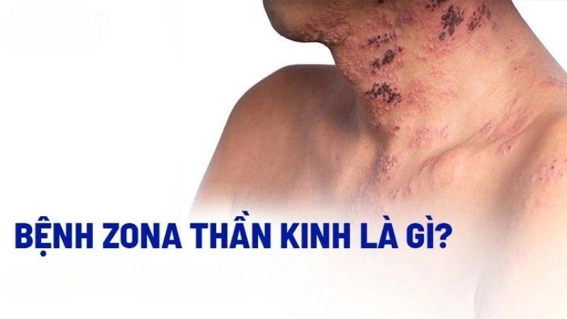 Zona thần kinh (Shingles hoặc Herpes Zoster) là một biến chứng của bệnh zona