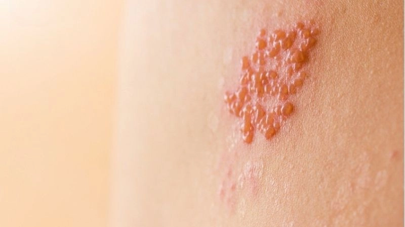 Phát ban nổi lên xuất hiện dưới dạng mụn nước mọc thành chùm