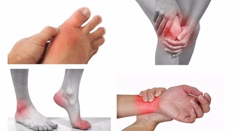 Viêm khớp là tình trạng viêm, sưng đau ở một hay nhiều khớp như khớp đầu gối, khớp háng, khớp vai, khớp cổ tay, khớp cổ… Đây là một bệnh lý thường gặp