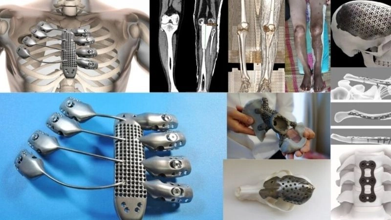 in 3D y học khi chế tạo được những phần xương nhân tạo từ vật liệu Titan
