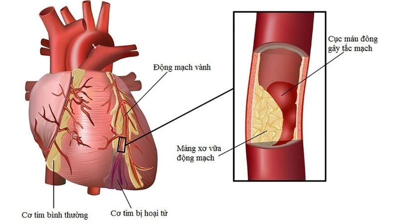 Huyết áp cao làm tăng áp lực của máu chảy qua các động mạch