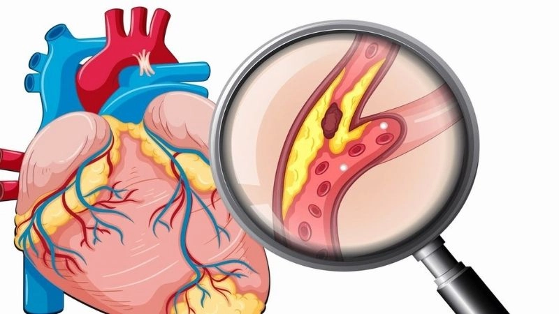  Các nghiên cứu hiện nay cho thấy rõ có 2 loại yếu tố và nguyên nhân của bệnh mạch 