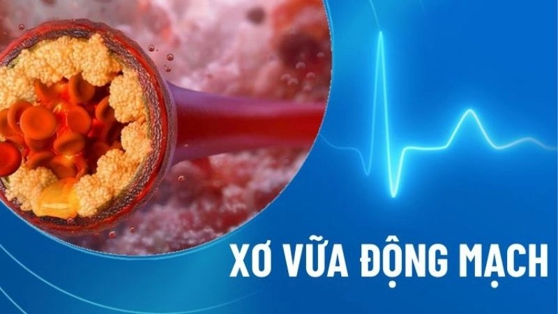 Căng thẳng tâm lý thúc đẩy quá trình vữa xơ động mạch