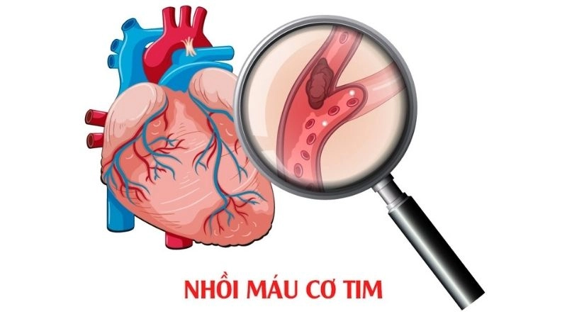 Xơ vữa động mạch là một trong những biến chứng nguy hiểm của mỡ máu cao