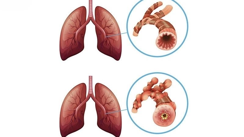  Bệnh phổi tắc nghẽn mãn tính, hay COPD là một trong những bệnh thường