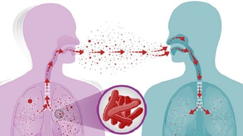 Đường hô hấp là con đường lây nhiễm bệnh lao từ người sang người nhanh nhất 