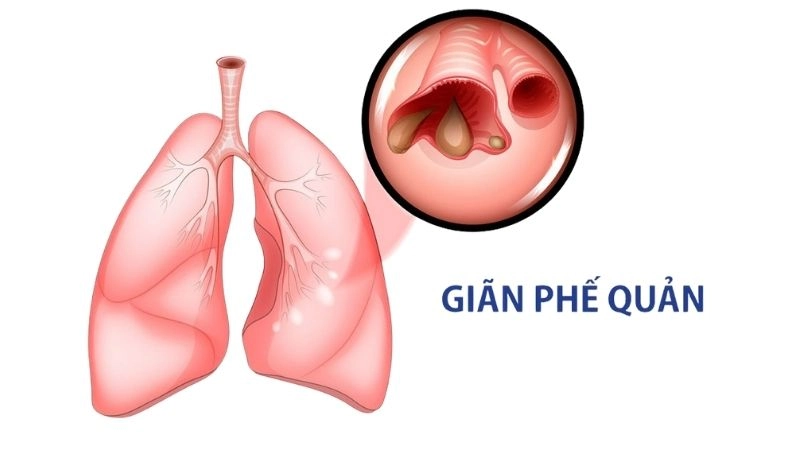 Giãn phế quản (tiếng Anh là Bronchiectasis) là tình trạng giãn không hồi phục một phần của cây phế quản