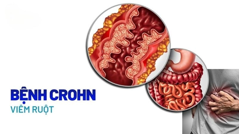 Bệnh Crohn là bệnh viêm đường ruột 