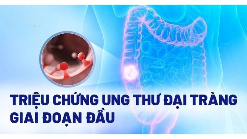  triệu chứng ung thư đại tràng giai đoạn đầu
