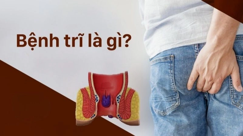 Bệnh trĩ là bệnh giãn tĩnh mạch của vùng hậu môn trực tràng