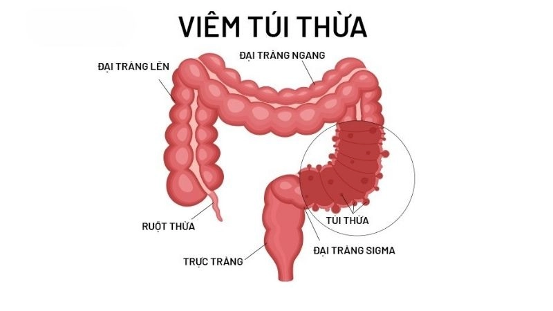 Viêm túi thừa là tình trạng viêm nhiễm xảy ra ở túi thừa