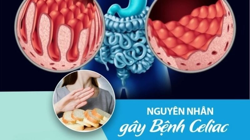 Bệnh Celiac thường sẽ không biểu hiện triệu chứng nếu không có yếu tố gây bệnh