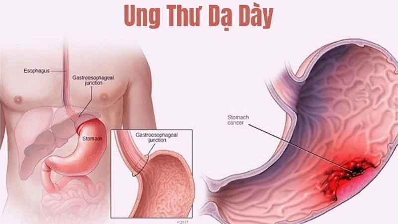 Ung thư dạ dày là một bệnh lý có phần nghiêm trọng
