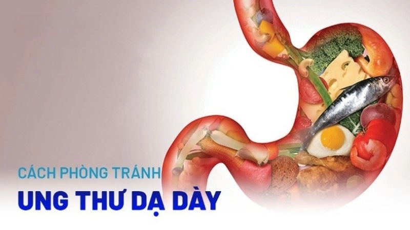 Cách phòng ngừa bệnh ung thư dạ dày
