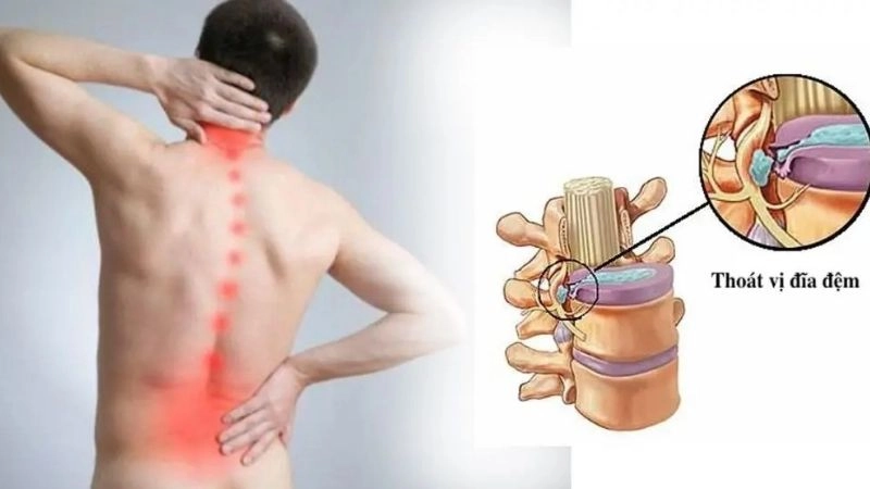 đau lưng dưới là triệu chứng đầu tiên của thoát vị đĩa đệm