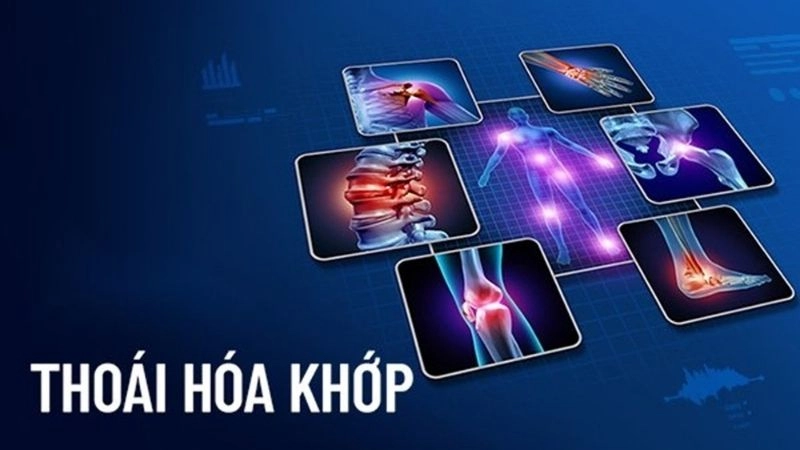 Thoái hóa khớp là một rối loạn mãn tính làm tổn thương sụn và các mô xung quanh khớp