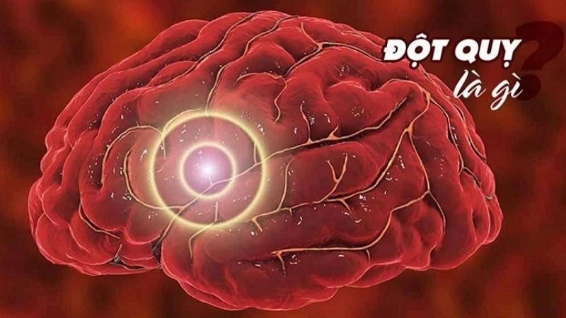 Đột quỵ (stroke) còn gọi là tai biến mạch máu não