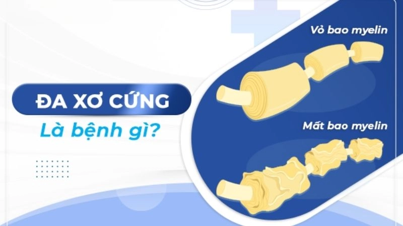Đa xơ cứng hay xơ cứng rải rác (Multiple Sclerosis, MS) là một bệnh hệ thần kinh ảnh hưởng đến não và tủy sống