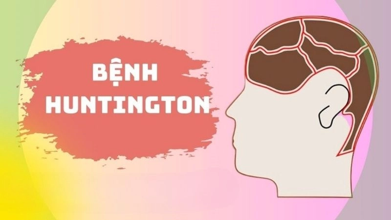 Bệnh Huntington là bệnh thoái hóa các tế bào não tiến triển