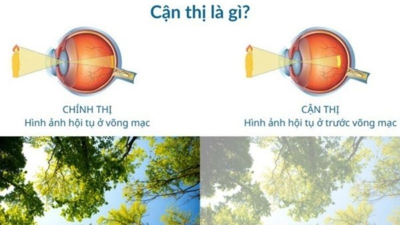 Cận thị (myopia) là tật khúc xạ phổ biến khiến người bệnh khó nhìn thấy vật ở xa