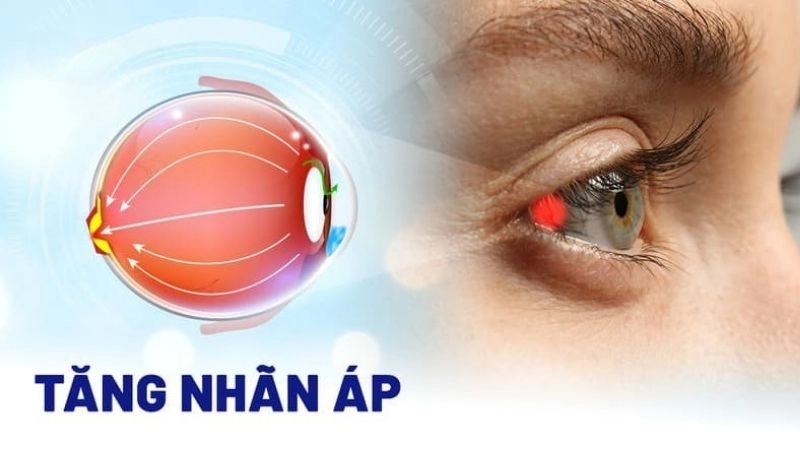 Tăng nhãn áp (hay còn gọi là tăng áp lực nội nhãn 
