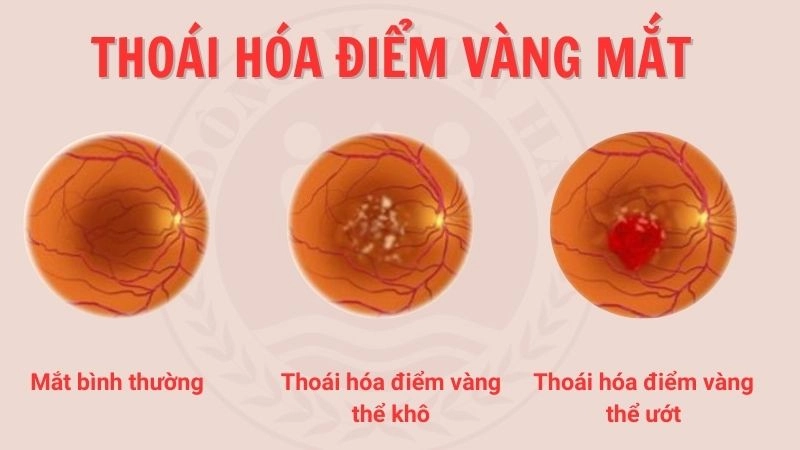 Thoái hóa điểm vàng hay còn gọi là thoái hóa hoàng điểm
