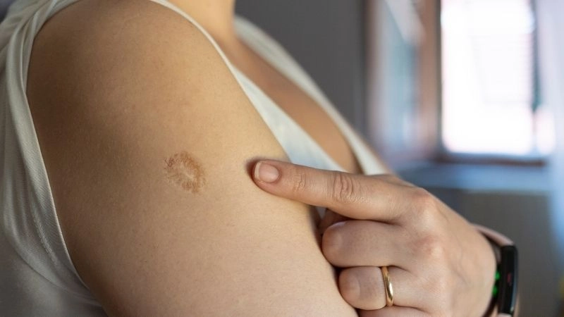 Vắc-xin đậu mùa và cách mạng y tế