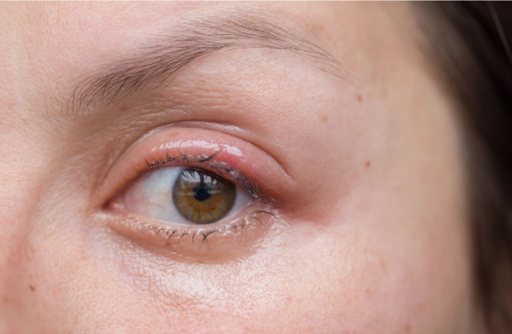 Triệu chứng viêm bờ mi dễ nhận biết sớm