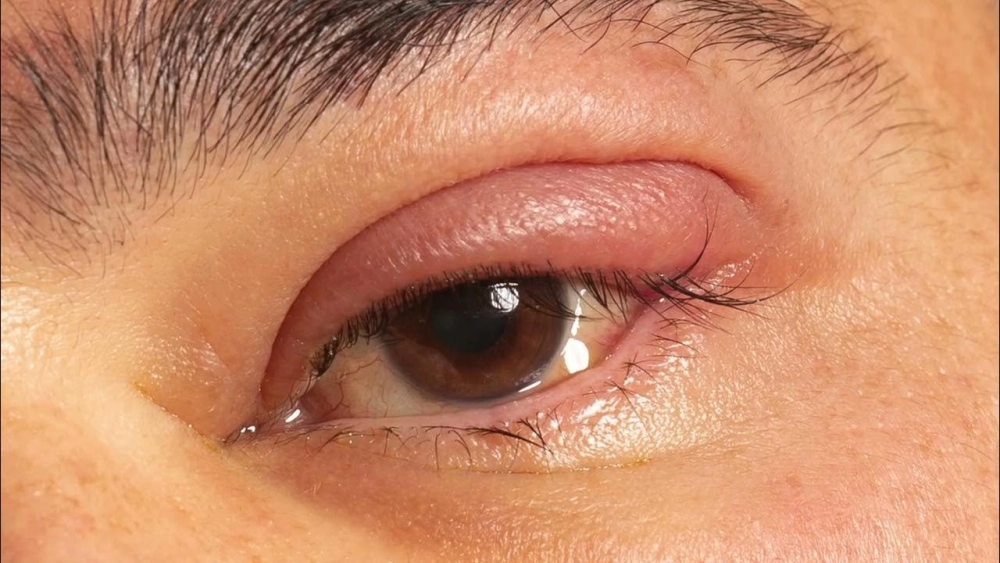 Dấu hiệu viêm bờ mi xuất hiện quanh mí mắt