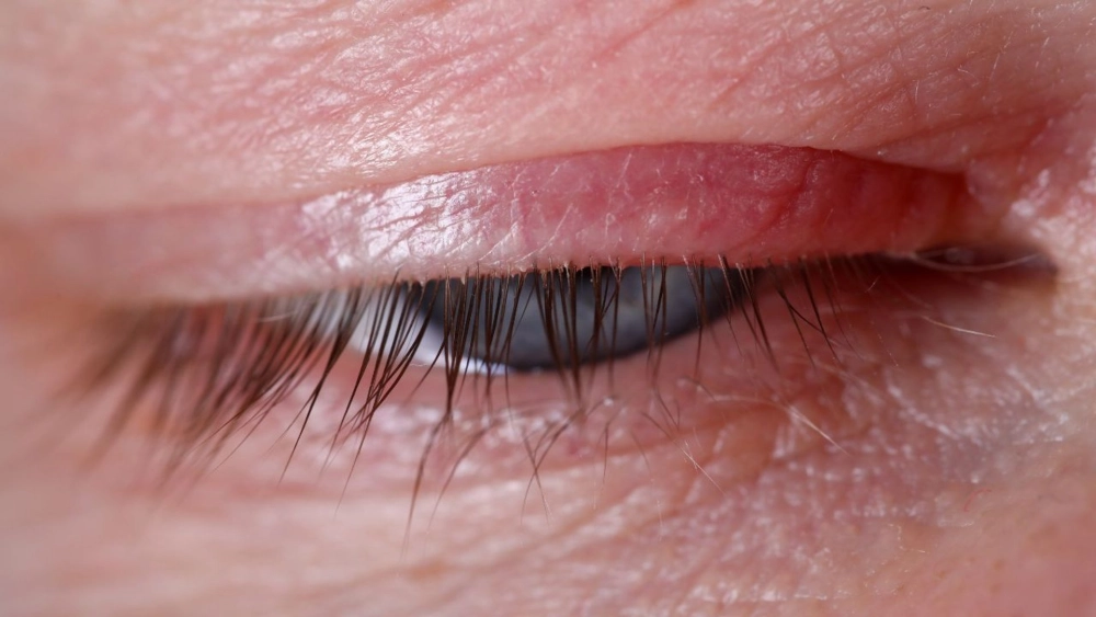 Viêm bờ mi cấp tính khởi phát nhanh chóng