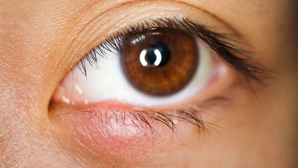 Cách chăm sóc khi viêm bờ mi rất quan trọng