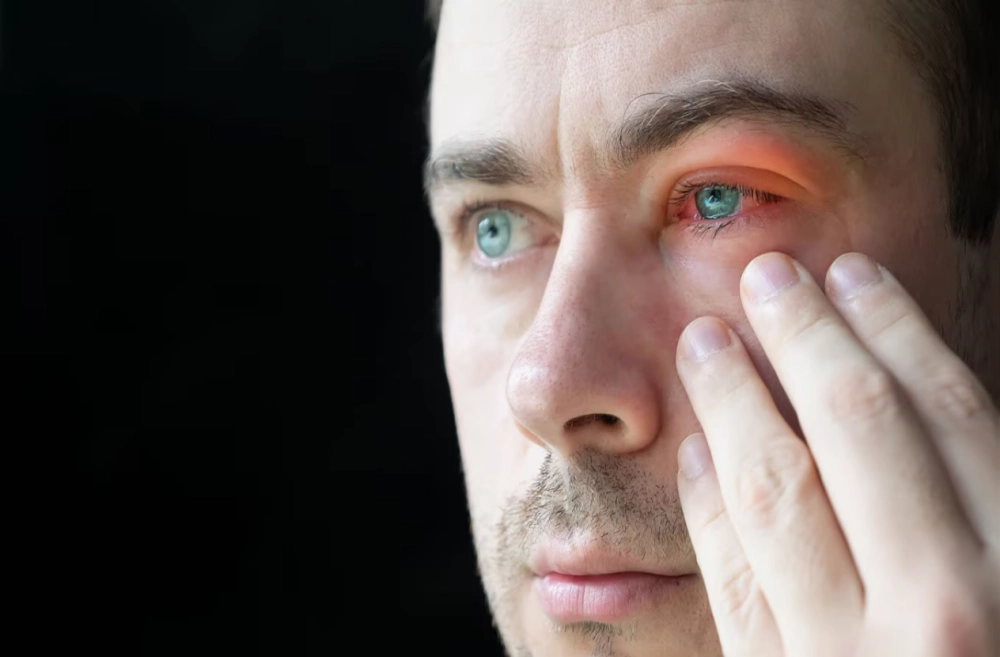 Viêm bờ mi thường gặp ở nhiều đối tượng